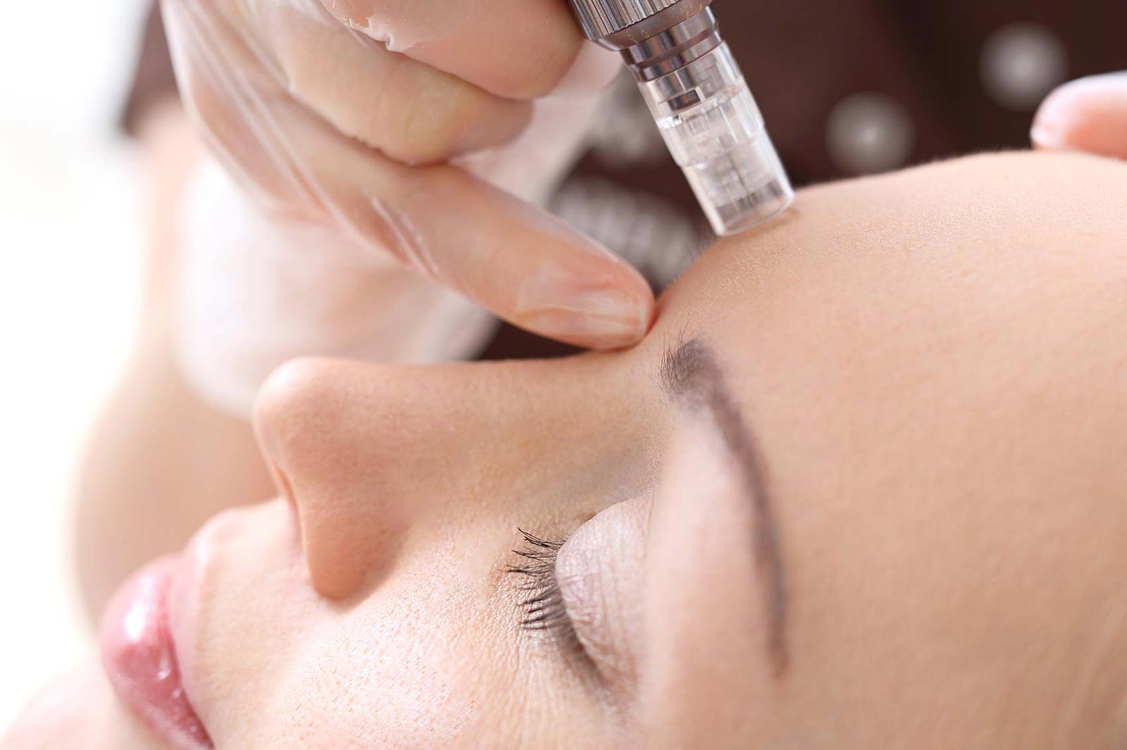 Microneedling | Centre de Laser l’Étoile La Ciotat