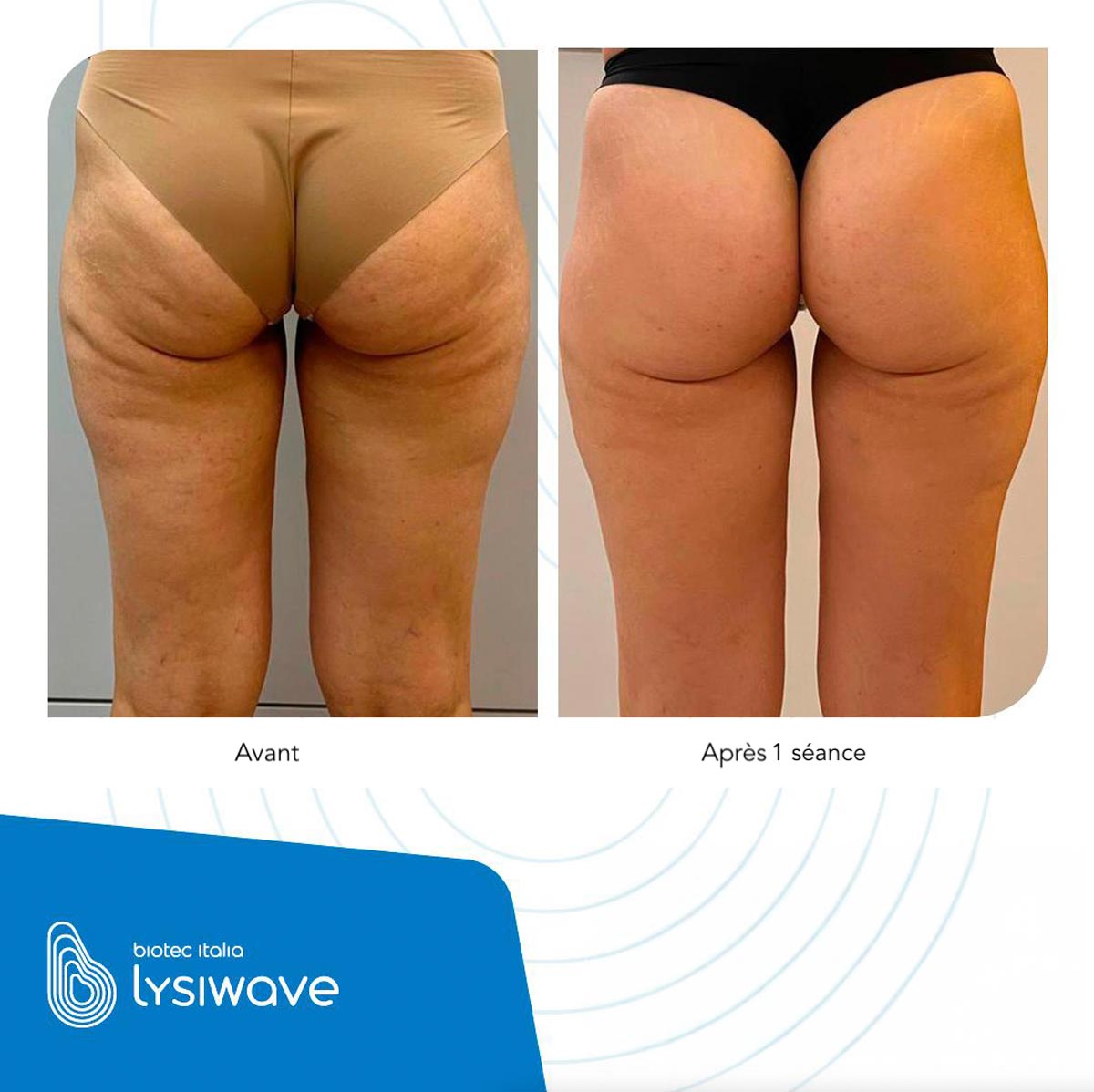 Traitement Cellulite Avant-Après | Centre de Laser l’Étoile La Ciotat