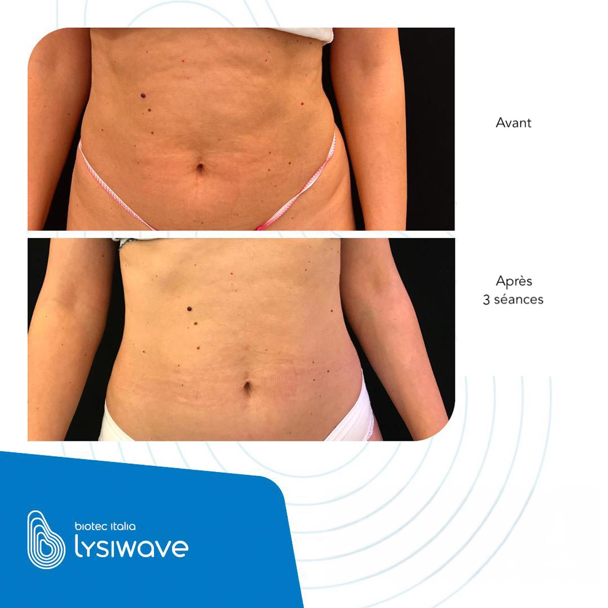 Traitement Cellulite Avant-Après | Centre de Laser l’Étoile La Ciotat