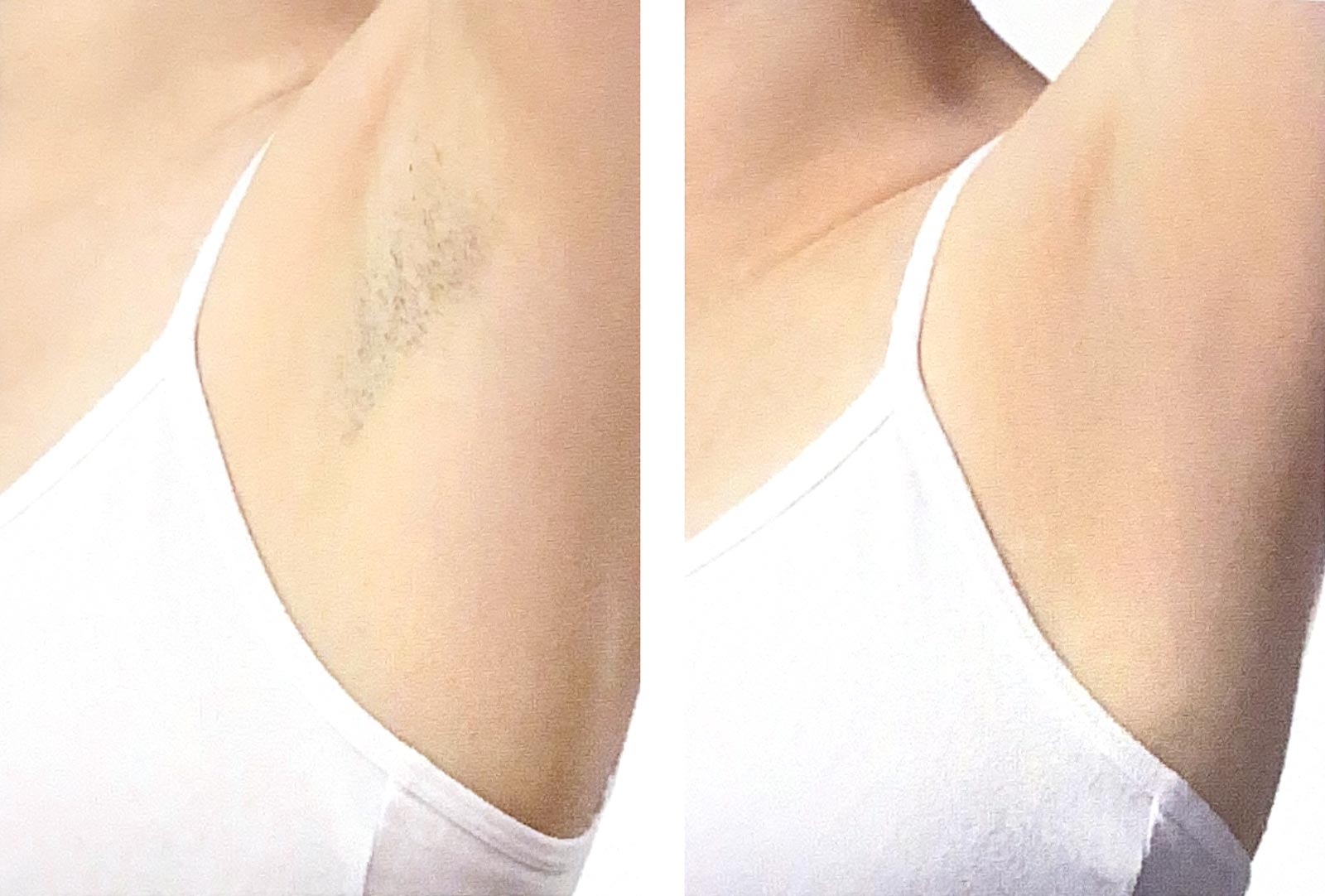 Epilation Définitive Avant-Après | Centre de Laser l’Étoile La Ciotat