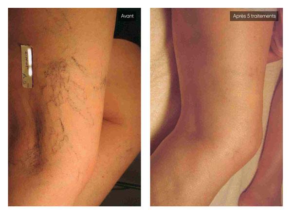 Traitement Varicosités Avant-Après | Centre de Laser l’Étoile La Ciotat