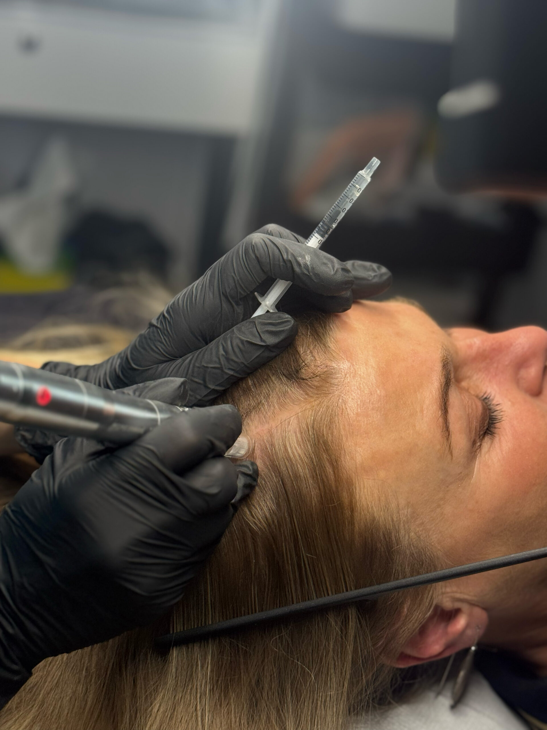 mésothérapie Traitement cheveux | Centre de Laser l’Étoile La Ciotat